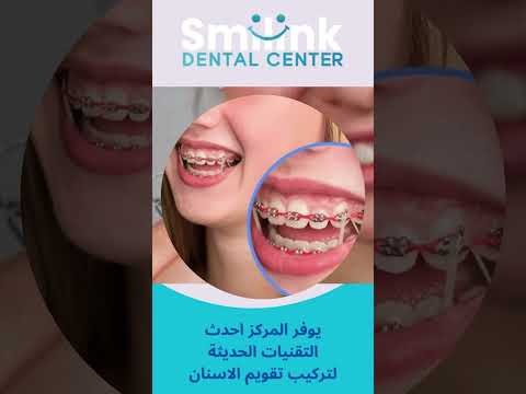 انواع تقويم الاسنان واسعارها