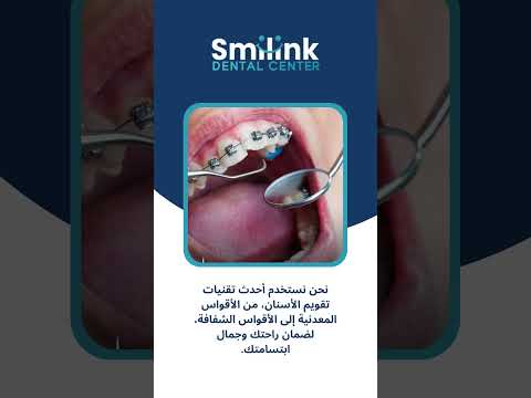 #dentistry سمايلينك #احدث تقنيات في تثقويم الاسنان #