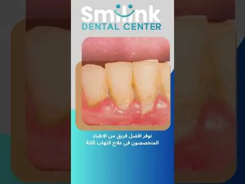 مركز سمايلنك من احسن المراكز المتقدمه في حل مشاكل الاسنان