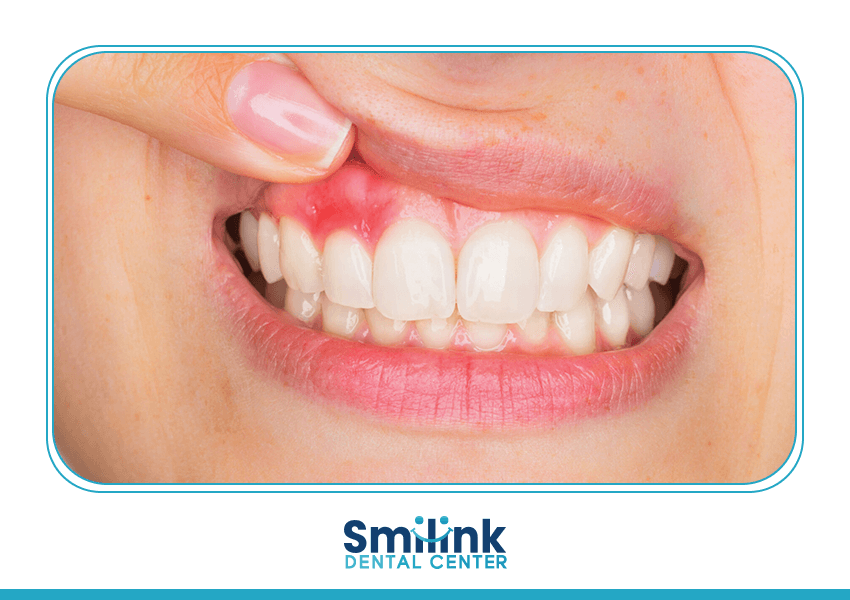 سمايل لينك | Gum treatment