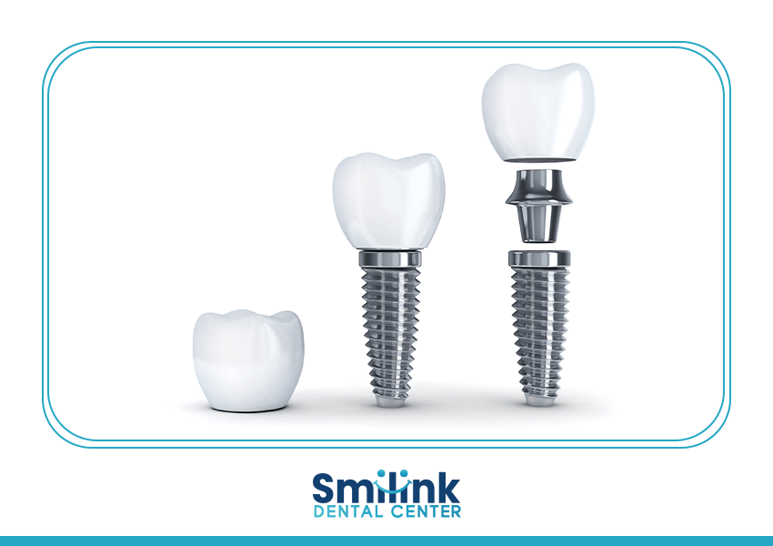 سمايل لينك | Dental implants