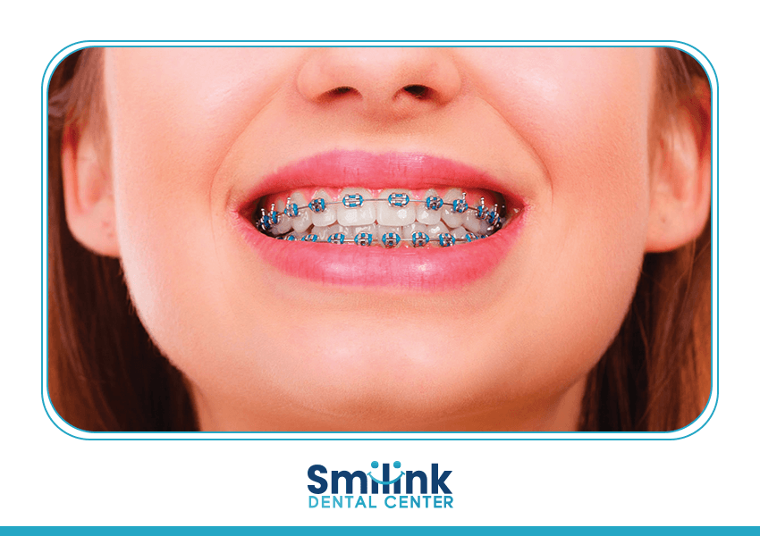 سمايل لينك | Orthodontics