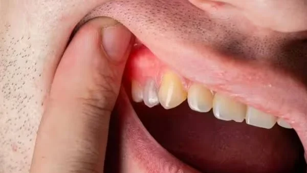 علاج التهاب اللثه وانتفاخها علاج التهاب اللثه وانتفاخها