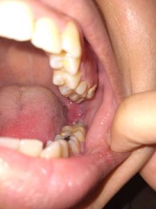 زراعة الضرس 1 زراعة الضرس