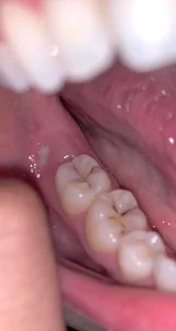 ما هو علاج التهاب اللثة سريع المفعول ما هو علاج التهاب اللثة سريع المفعول