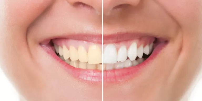 تبييض الأسنان: الفرق بين العيادة والمنزلي