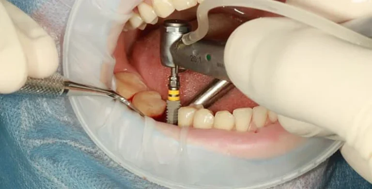 نصائح العناية اليومية بعد زراعة أو تجميل الأسنان 01155558285&nbsp;