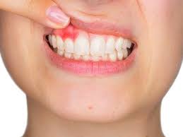 سمايل لينك | علاج التهاب الأسنان واللثة