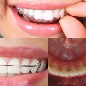 سمايل لينك | مثبت الاسنان بعد التقويم الشفاف