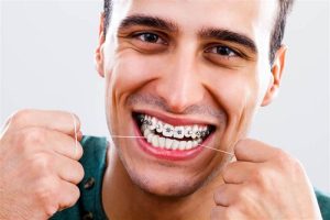 انواع تقويم الاسنان المعدني