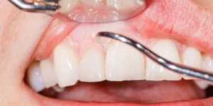 علاج لالتهاب اللثة