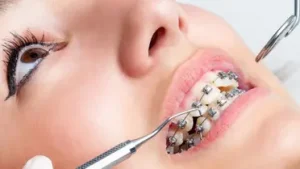 سمايل لينك | انواع تقويم الاسنان المعدني