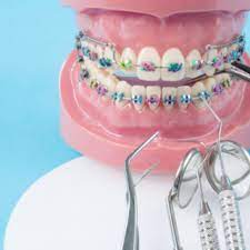 سمايل لينك | انواع تقويم الاسنان بالصور