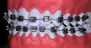 سمايل لينك | انواع تقويم الاسنان وافضلها