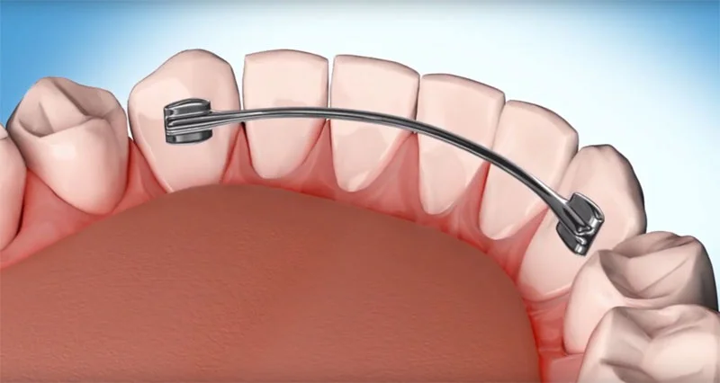 سعر مثبت الاسنان بعد التقويم