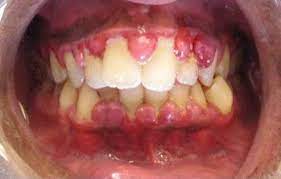 سمايل لينك | علاج التهاب الاسنان واللثه