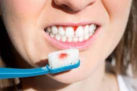 سمايل لينك | علاج التهابات اللثة والأسنان
