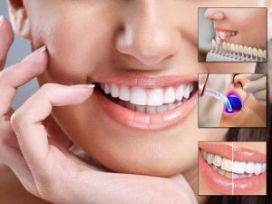 اسعار تبييض الاسنان بالليزر اسعار تبييض الاسنان بالليزر