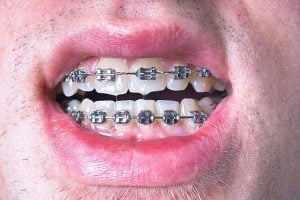 مركز تركيب تقويم اسنان