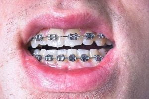 سمايل لينك | مركز تركيب تقويم اسنان