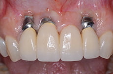 سمايل لينك | مراحل زراعة الأسنان
