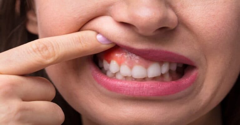 اسباب التهاب اللثة