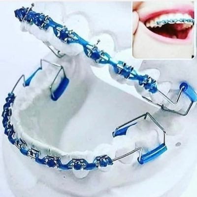 افضل الوان تقويم الاسنان