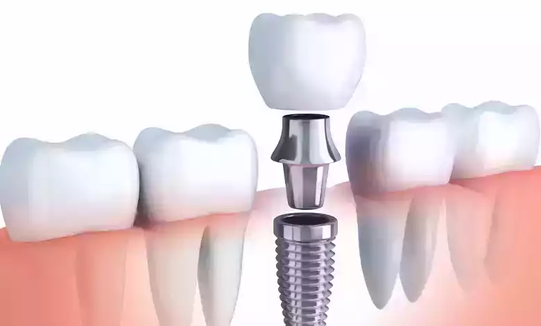 عيوب زراعة الاسنان عيوب زراعة الاسنان