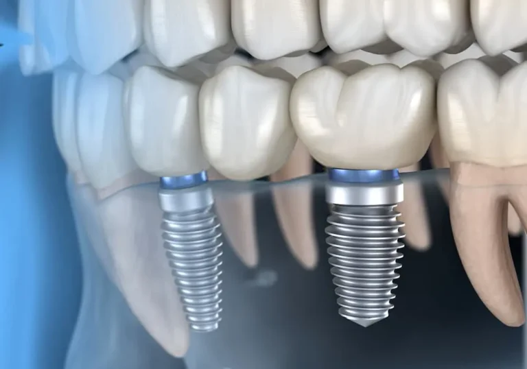 خطوات زراعة الأسنان في مركز سمايلينك