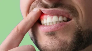 علاج التهاب اللثه حول الضرس
