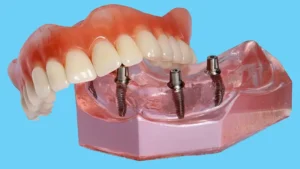 أهم عيوب زراعة الأسنان