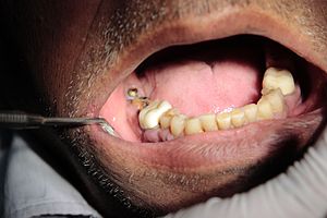 سمايل لينك | طريقة زراعة الأسنان