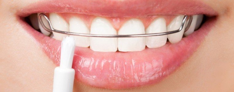 اسعار تقويم اسنان اسعار تقويم اسنان