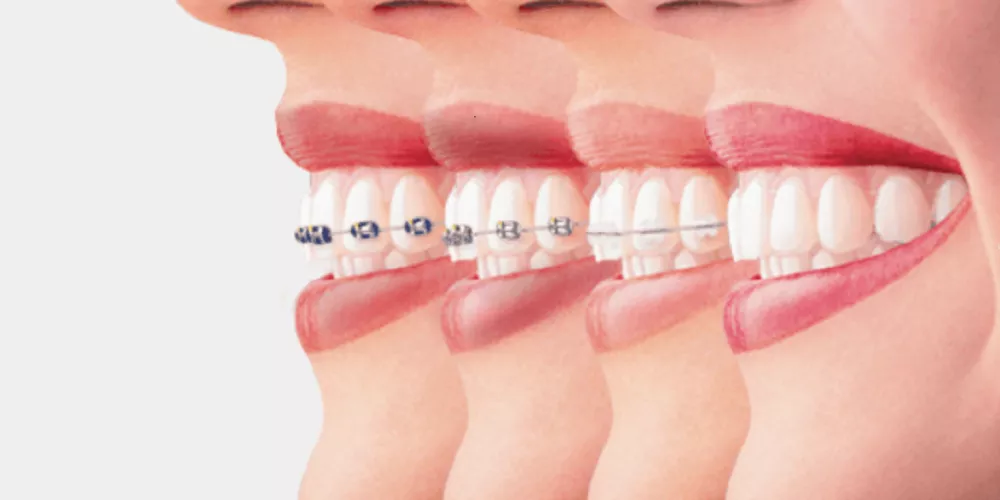 سمايل لينك | أنواع تقويم الأسنان بالصور واسعارها