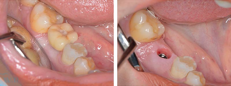 سمايل لينك | اضرار زراعة الاسنان الفورية
