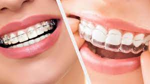 سمايل لينك | أنواع تقويم الأسنان