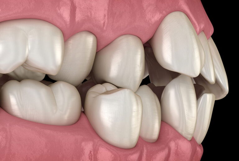 أسعار تجميل الأسنان في مصر