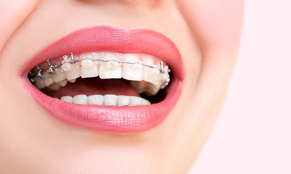 سمايل لينك | أنواع التقويم الأسنان