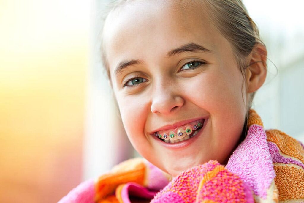 سمايل لينك | انواع تقويم الاسنان للاطفال