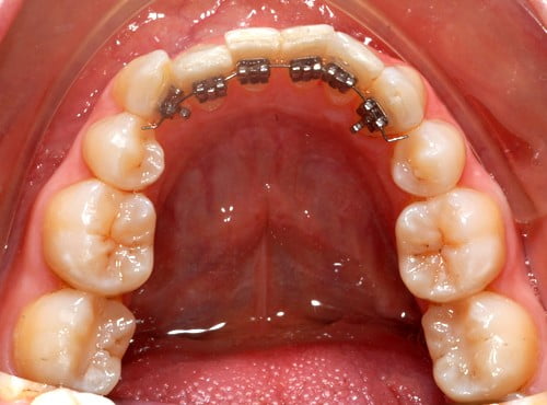سمايل لينك | شكل الأسنان بعد التقويم
