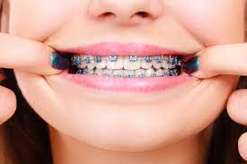 سمايل لينك | فوائد تقويم الأسنان