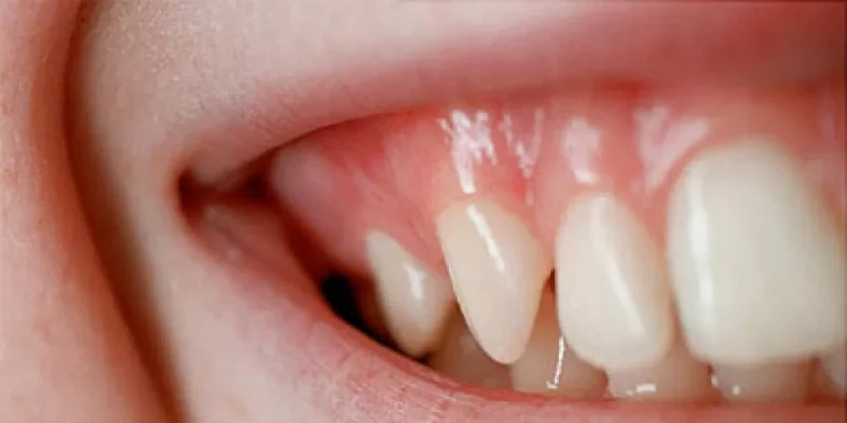 علاج التهاب اللثة والأسنان