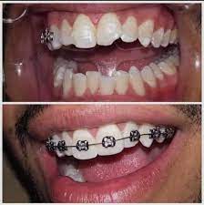 سمايل لينك | شروط تركيب تقويم الأسنان