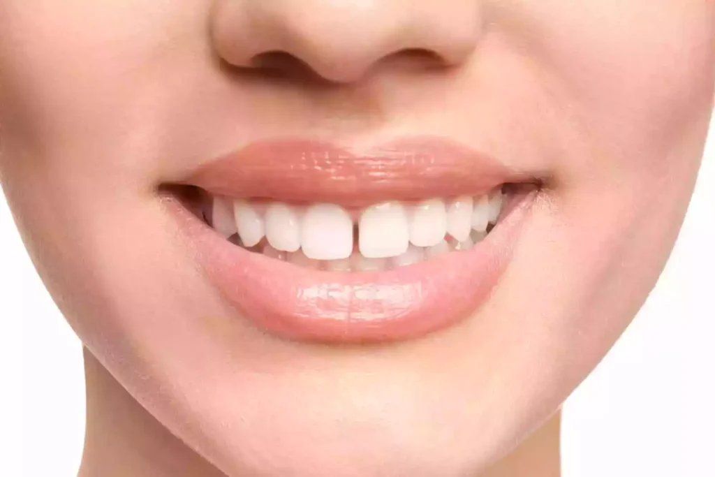 الحشوات التجميلية لسد الفراغات بين الأسنان