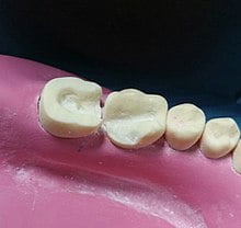 حشو الاسنان التجميلي حشو الاسنان التجميلي