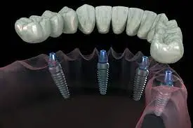 اسعار تركيبات الاسنان اسعار تركيبات الاسنان