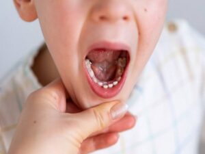علاج التهاب اللثة حول الضرس عند الاطفال
