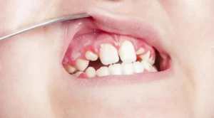 علاج التهاب اللثة حول الضرس عند الاطفال