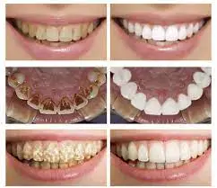 تجميل اسنان قبل وبعد