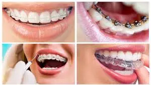 أنواع تقويم الأسنان بالصور